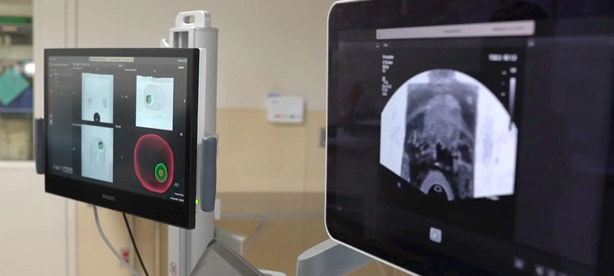 Uronav Machine UroNav MR/Ultrasound Fusion Biopsy | United Regional Health Care System ...